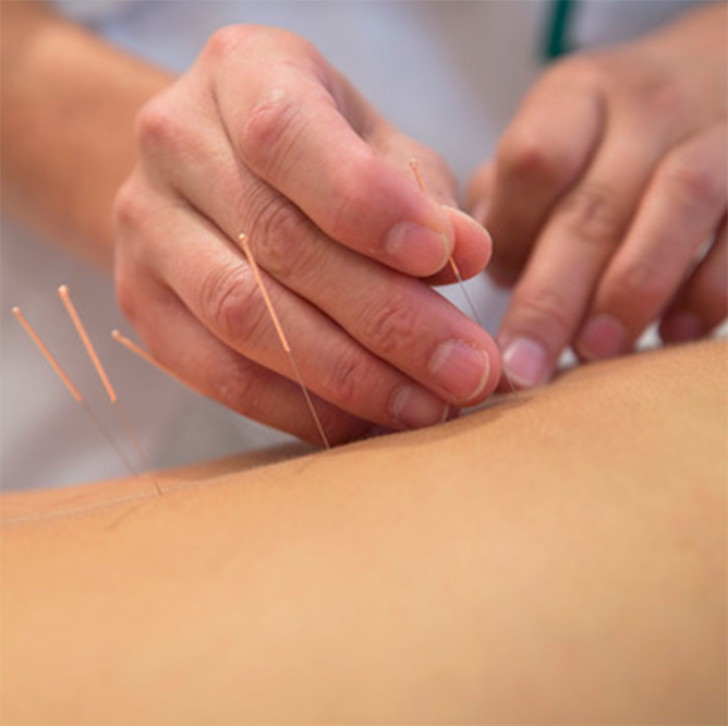 acupuncture-treatment-lg acupuncture-treatment